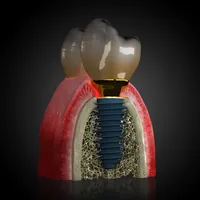 Cross-section of a MegaGen AnyRidge implant in bone, with a crown, official image from the manufacturer