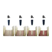 MegaGen AnyRidge implant shown in bone of four different densities, D1 to D4