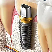 Illustration of an Osstem TS implant in bone, between two teeth