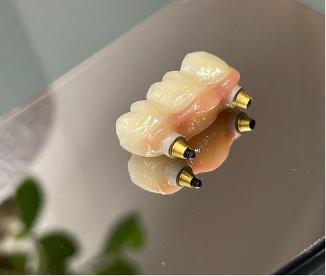 A partial denture produced by Creadent's laboratory, Tirana