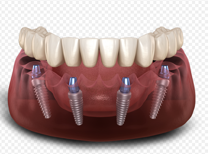 Full-Arch Rehabilitation on Implants