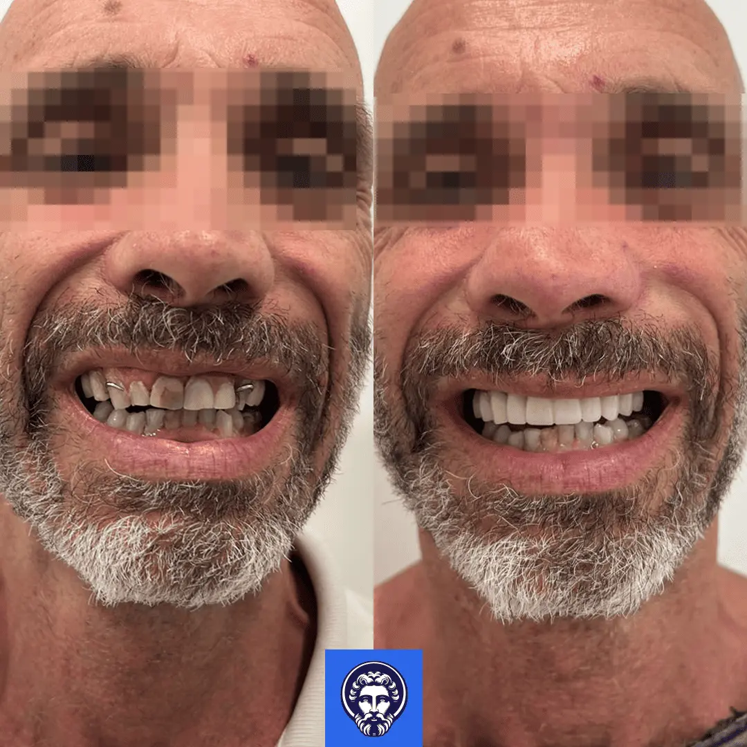 Prima e dopo trattamento dentale