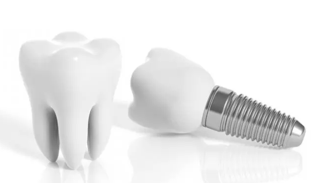 Dental Implant