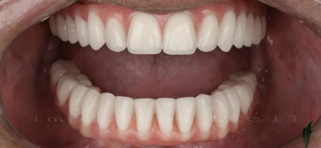 Clinical case 1 after treatment — implants and prosthetics, Kokona Dental, Tirana (real case, individual results vary)