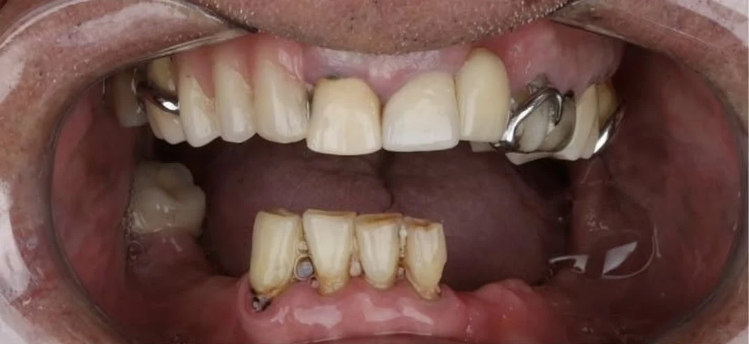 Clinical case 1 before treatment — implants and prosthetics, Kokona Dental, Tirana (real case, individual results vary)