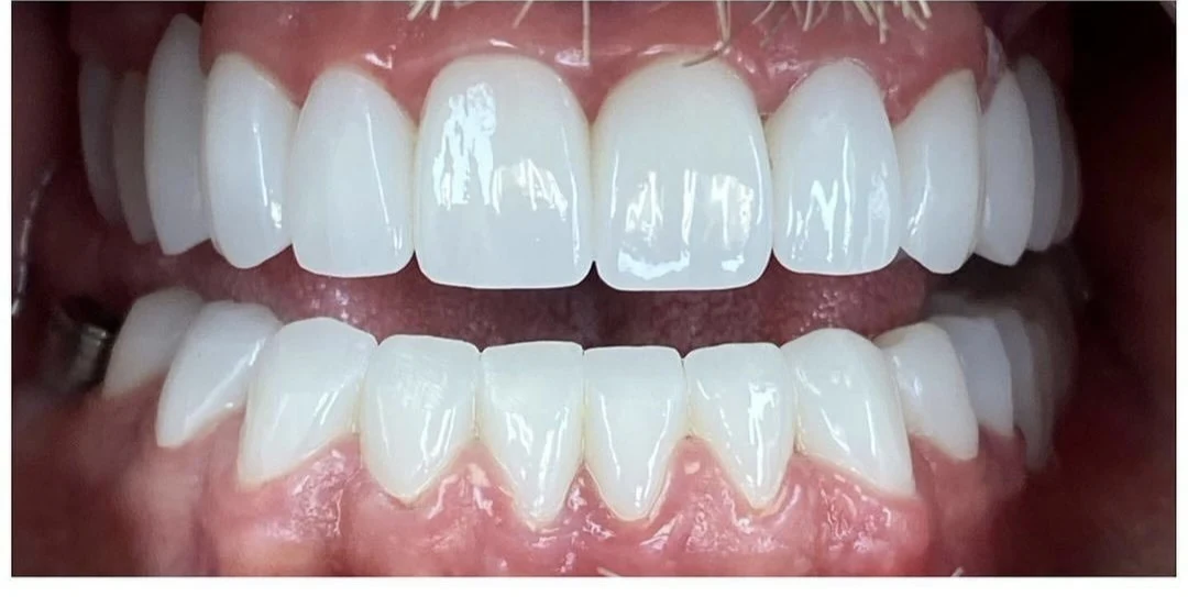Clinical case 1 after treatment — implants and prosthetics, San Marco Dental, Tirana (real case, individual results vary)