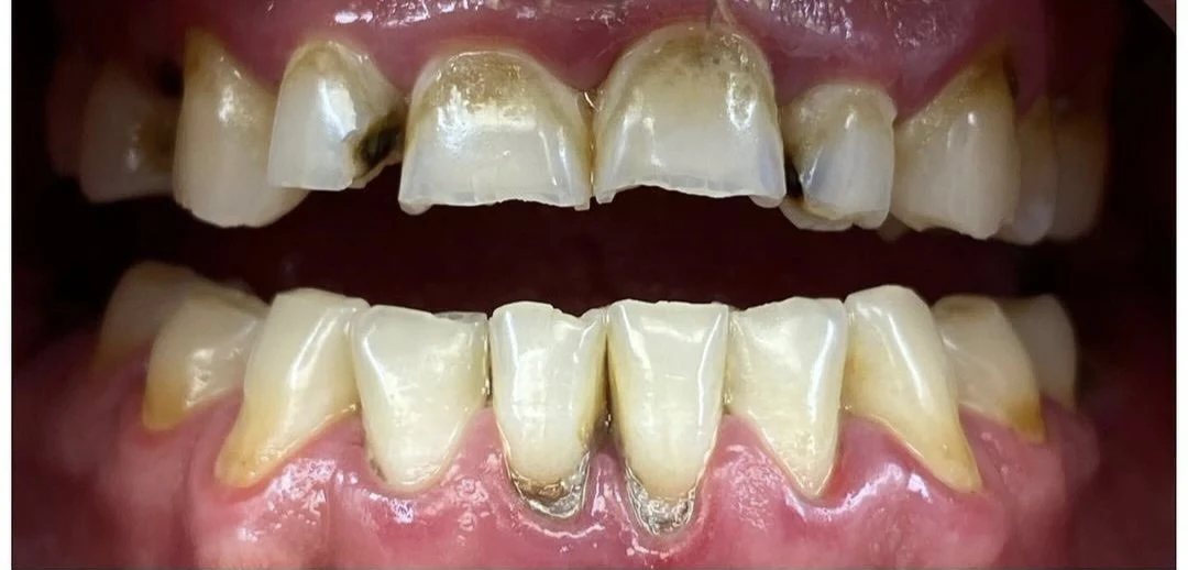 Clinical case 1 before treatment — implants and prosthetics, San Marco Dental, Tirana (real case, individual results vary)
