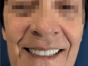 Clinical case 2 after treatment — implants and prosthetics, San Marco Dental, Tirana (real case, individual results vary)