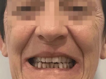 Clinical case 2 before treatment — implants and prosthetics, San Marco Dental, Tirana (real case, individual results vary)
