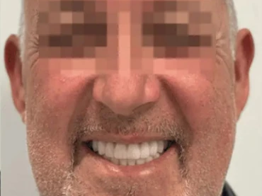 Clinical case 4 after treatment — implants and prosthetics, San Marco Dental, Tirana (real case, individual results vary)