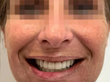 Clinical case 5 after treatment — implants and prosthetics, San Marco Dental, Tirana (real case, individual results vary)