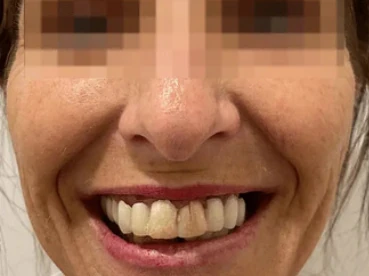 Clinical case 5 before treatment — implants and prosthetics, San Marco Dental, Tirana (real case, individual results vary)